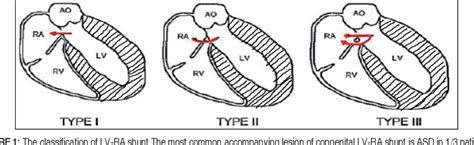 lv shunt borstreconstructie|Acquired Left Ventricle to Right Atrial Shunt (Gerbode Defect.